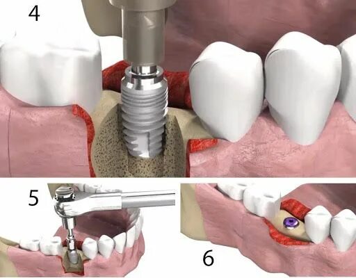 Порядок установки имплантов зубов пошагово с фото Имплантация зубов: этапы, установка зубного импланта пошагово - клиника Доктора 
