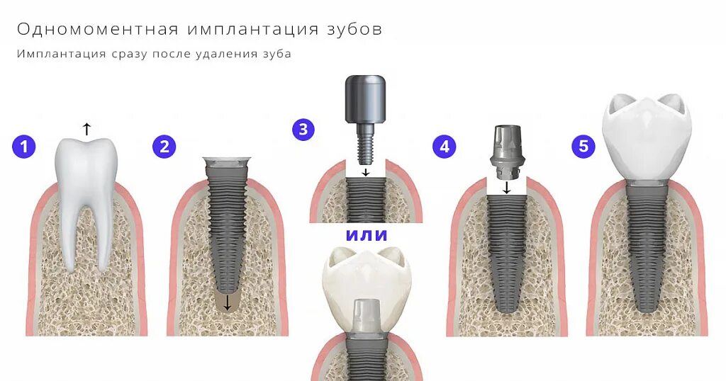 Порядок установки имплантов зубов пошагово с фото Одномоментная имплантация зубов в Москве Быстрая и эффективная замена потерянных