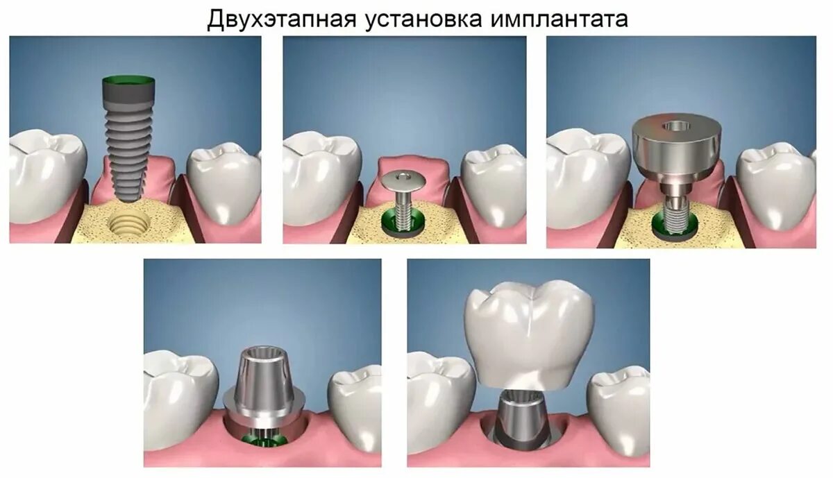 Порядок установки имплантов зубов пошагово с фото Имплантация с отсроченной нагрузкой в Уфе, цена от 18000 руб.