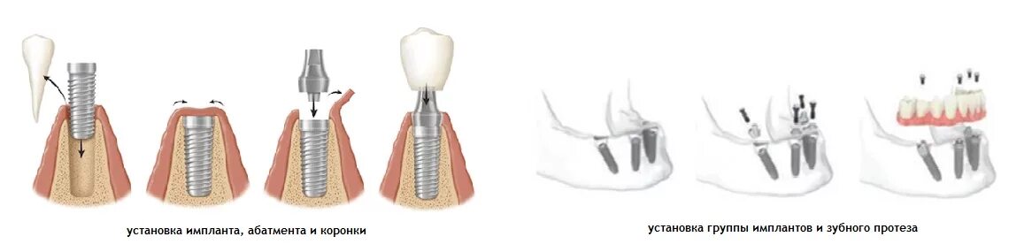 Порядок установки имплантов зубов пошагово с фото Имплантация зубов в Калининграде и доступная цена - Ортодонт в Калининграде в ст