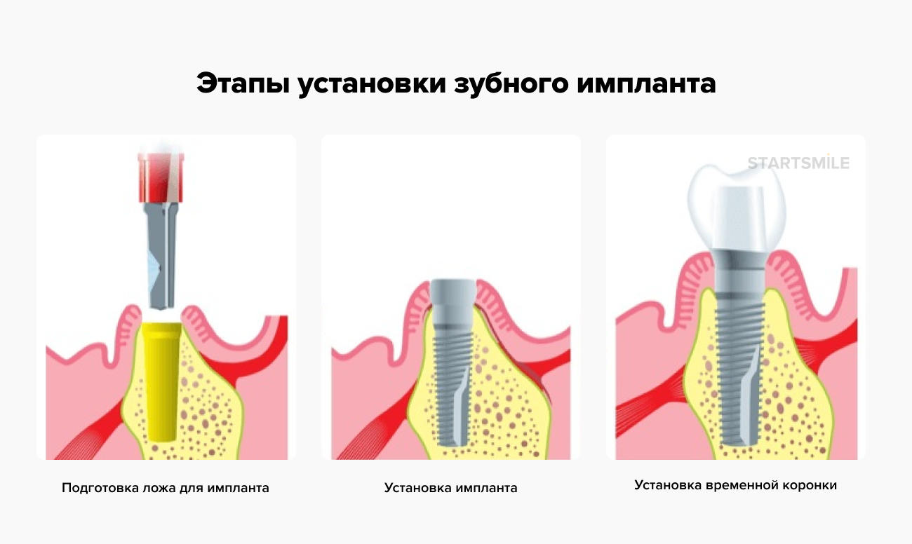 Порядок установки имплантов зубов пошагово с фото Имплантация зубов - этапы, виды, фото, как делают операцию по установке зубного 