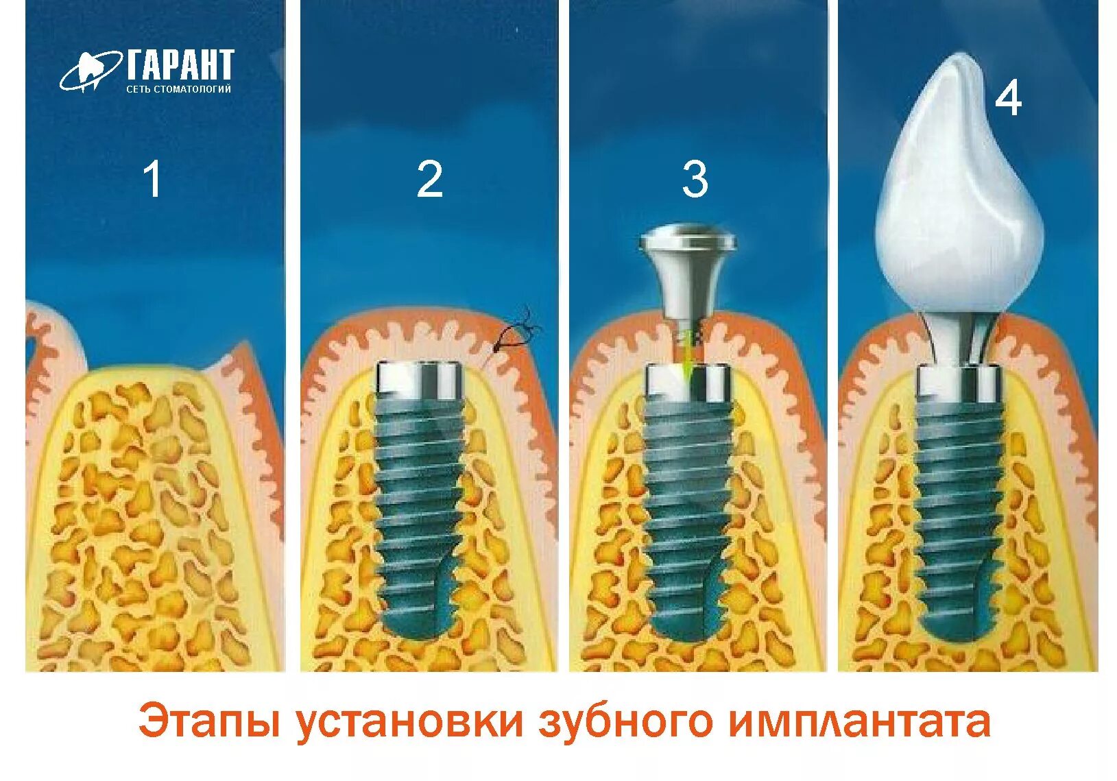 Порядок установки имплантов зубов пошагово с фото Порядок установки имплантов - найдено 87 картинок