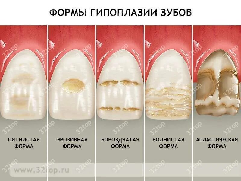 Посеребренные зубы у детей как выглядят Лучшая имплантация зубов в СПб. Гипоплазия зубов Центр имплантации зубов в СПб