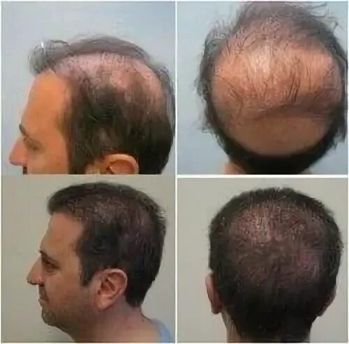 После 2 месяцев пересадки волос фото "#maac is one of the #best #hair #transplant #clinic in #bangalore which provide