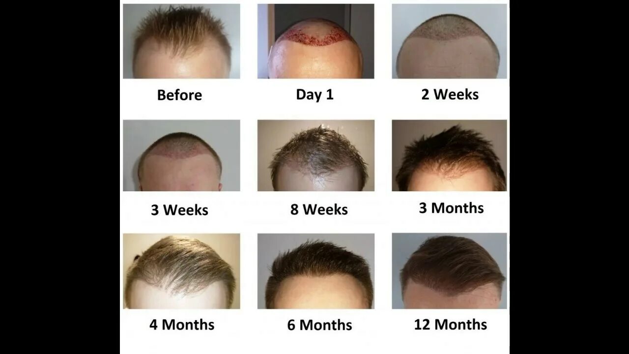 После 2 месяцев пересадки волос фото Hair Transplant Explained in Tamil முடி வளர்ப்பு இவ்ளோ ஈசியா !!! - YouTube