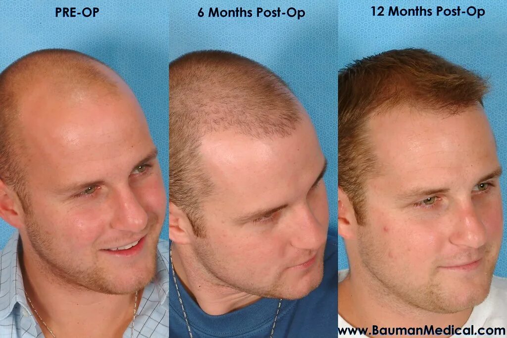 После 2 месяцев пересадки волос фото Hair Transplant Before & After_AG12_04 Patient "A.G." is a. Flickr