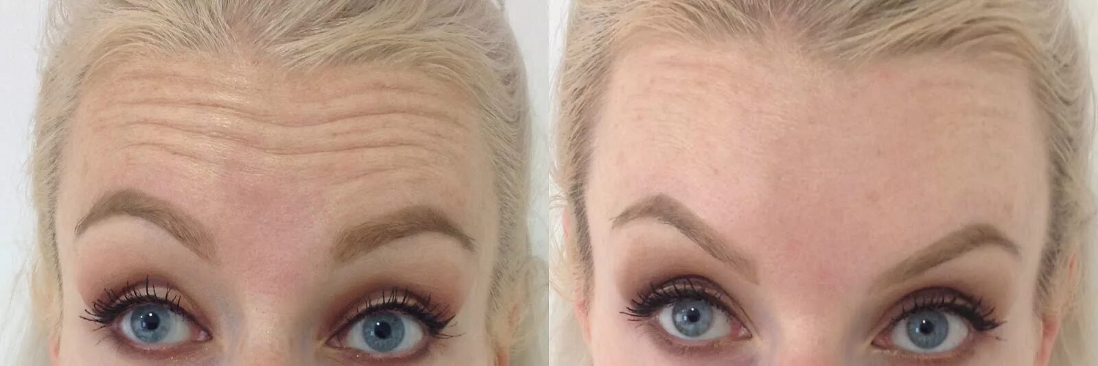 После ботокса делать татуаж Bump Above Eyebrow After Botox - Release Date Price Reviews