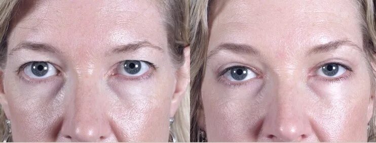 После ботокса опустились веки что делать фото New Jersey Eyelid and Brow lift Surgery at the Parker Center Discovers a Minimal