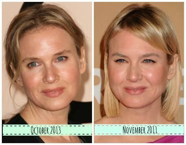 После ботокса опустились веки что делать фото Renee Zellweger now and then - What did she do to her face?? Renee zellweger, Pl