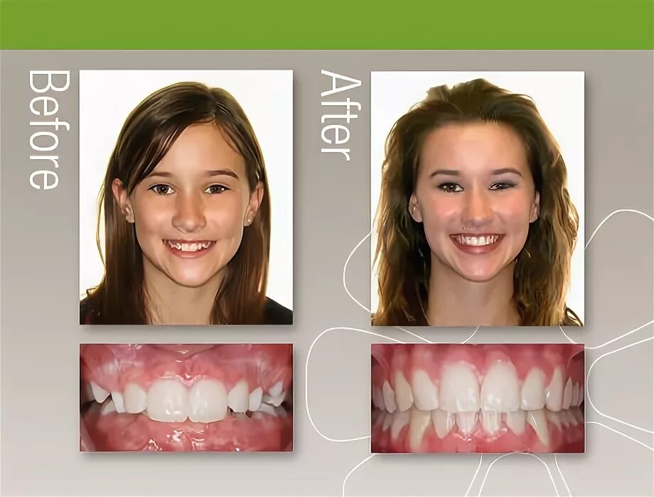 После брекетов изменилось лицо фото Jorgensen Orthodontics Smile of the Month Orthodontics, Orthodontics smile, Gett