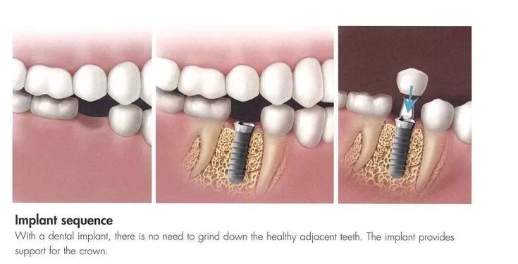 После импланта как выглядит зуб Versed Tooth Implant Recovery #teethwhiteningthatworks #ToothImplantRecovery Tee