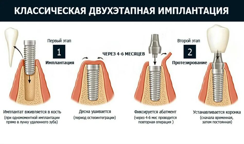 После имплантации зуба фото как выглядит Какой имплант (имплантат) лучше поставить: признаки сравнения, топ 6 систем импл