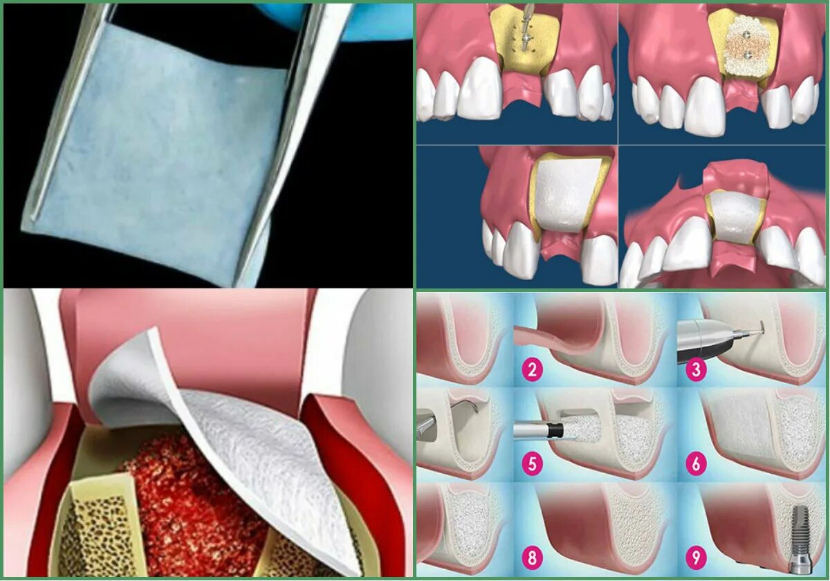 После костной пластики фото Что такое костная трансплантация? Стоматология Королевская улыбка Дзен