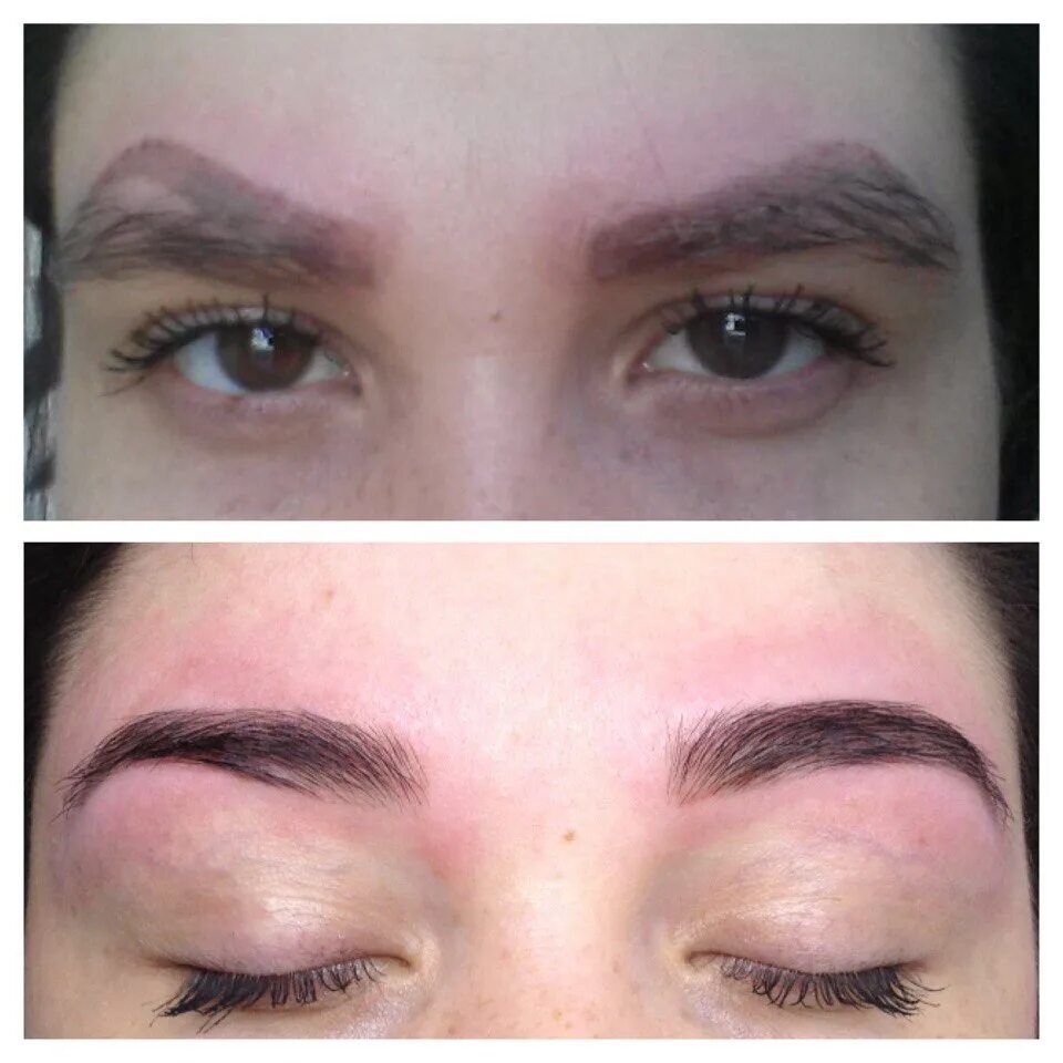 После лазерного удаления бровей фото Removal of permanent eyebrow makeup by laser .Result after 4 procedures, ahead o