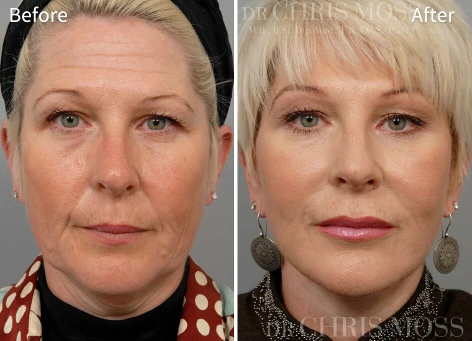 После мезотерапии лица фото уколы Face Lift & Neck Lift Results - Before and After Face lift surgery, Facelift, Ch