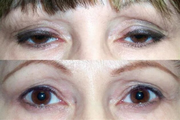 После операции птоз верхнего века фото Cosmetic and Reconstructive Surgery of eyelids, orbits, and tear ducts