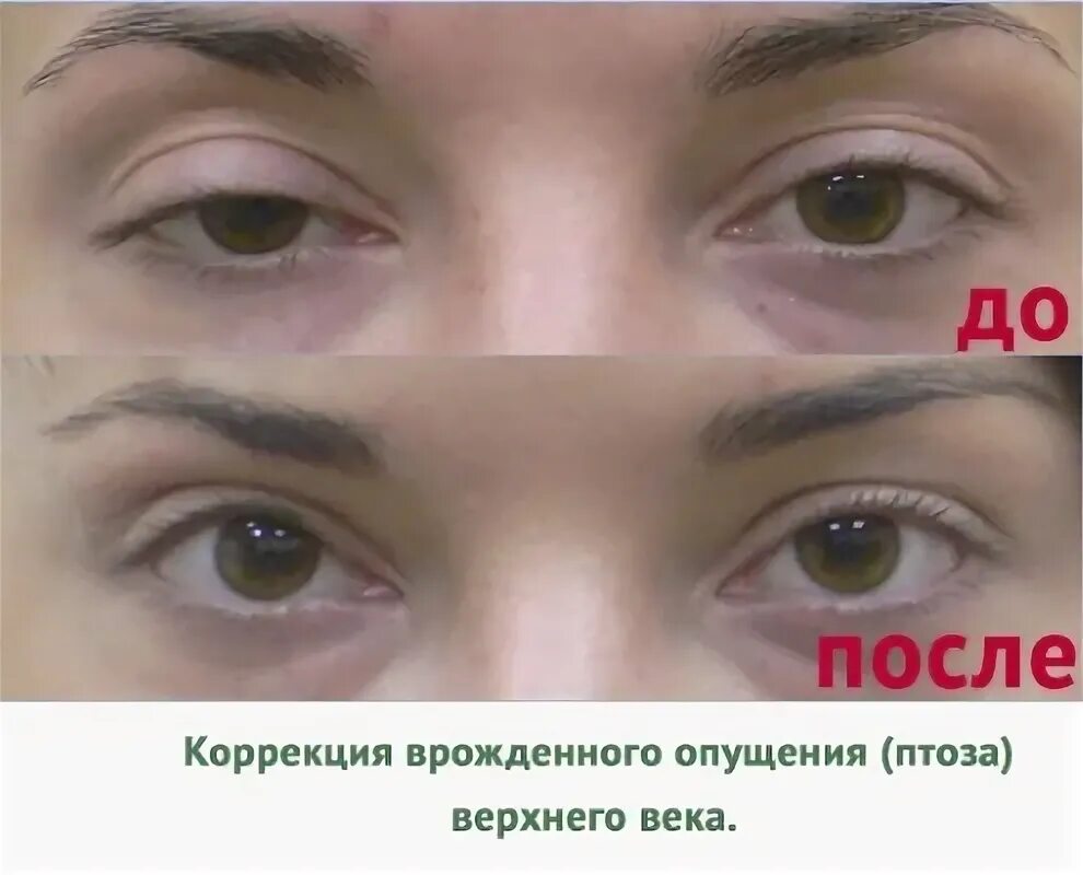 После операции птоз верхнего века фото A non-surgical blepharoplasty upper, lower eyelids. Before & After: circular, la