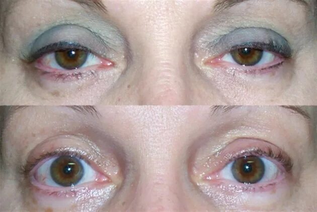 После операции птоз верхнего века фото blepharoplasty ptosis Cheaper Than Retail Price Buy Clothing, Accessories and li