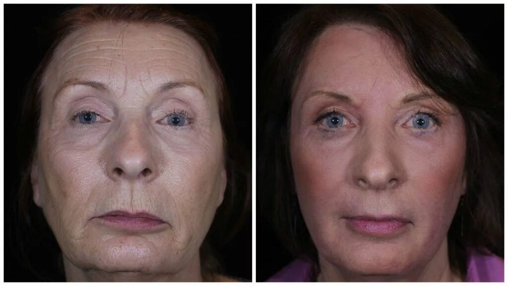 После плазмолифтинга лица фото отзывы эффект Plasma Termal Skin To Remove Wrinkle Cheap Sale xn--h1aahyg1df.xn--p1ai