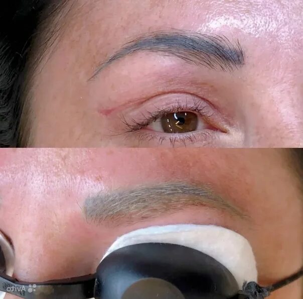 После удаления перманентного макияжа лазером Not every time permanent makeup is completed successfully, and after a while it 