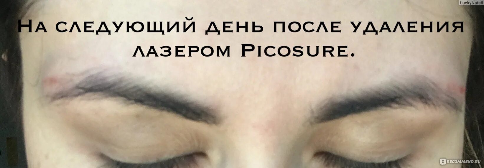 После удаления перманентного макияжа лазером Лазерное удаление татуажа - "Удаление татуажа бровей на первом в мире пикосекунд