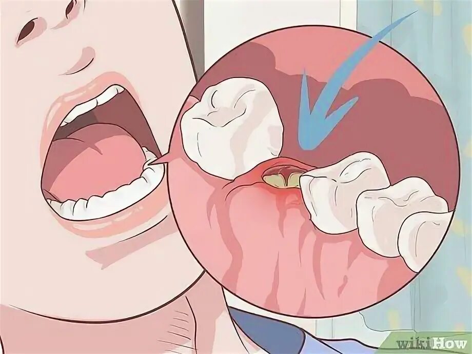 После удаления зуба фото по дням Effective Tooth Extraction Aftercare Tips for a Healthy Recovery