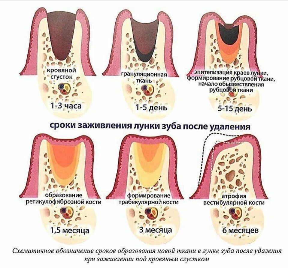 После удаления зуба фото по дням Через сколько убрать вату после удаления зуба