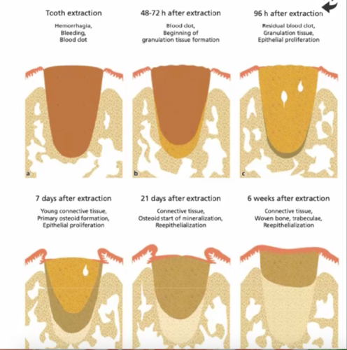 После удаления зуба фото по дням Alveolar Ridge Preservation and Immediate Implant Placement (Biologic and Surgic