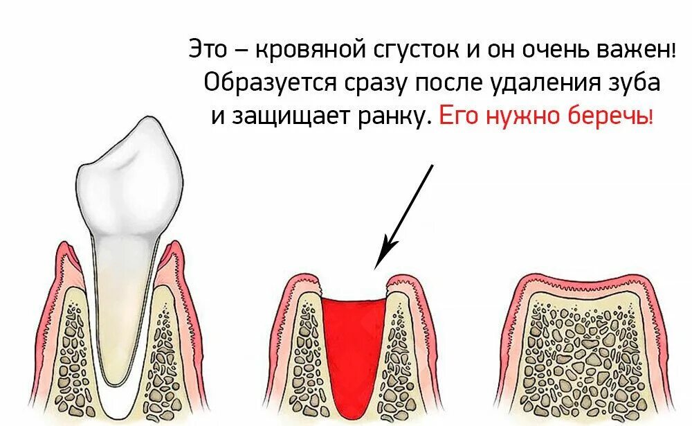 После удаления зуба фото по дням Что делать после удаления зуба - стоматологическая клиника Эталон Ростов