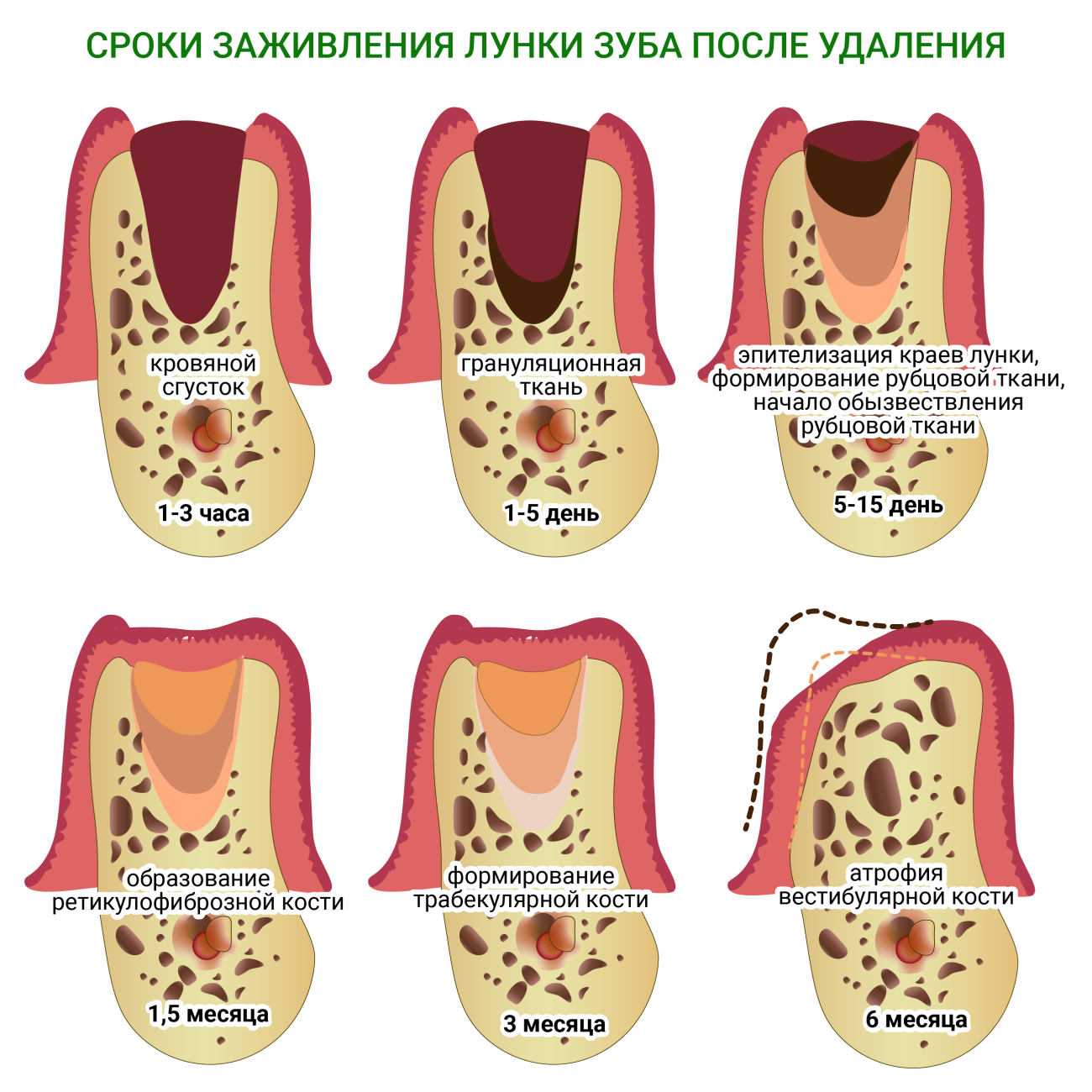 После удаления зуба фото по дням Уход после удаления зуба: полоскание, антисептики