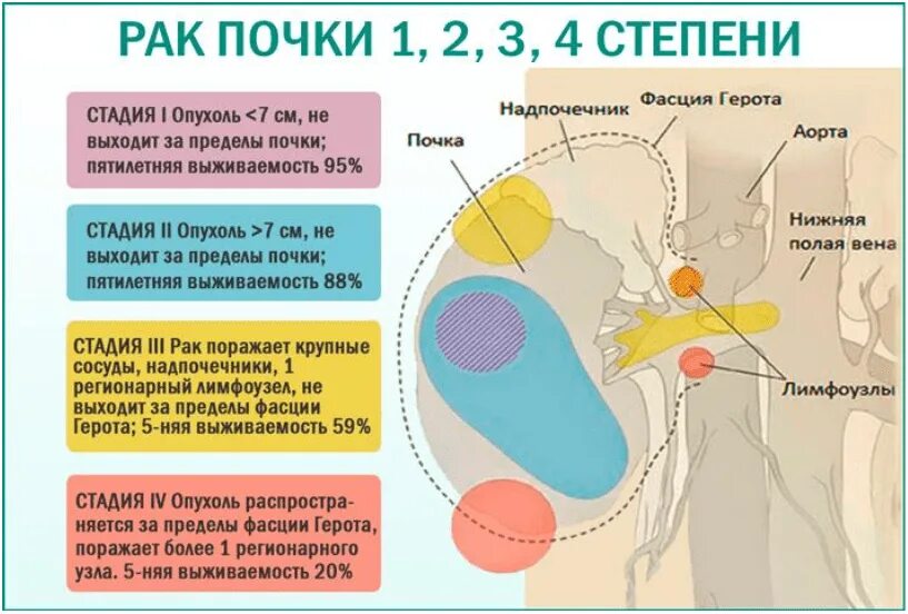 Последние стадии рака фото Злокачественные опухоли почек.