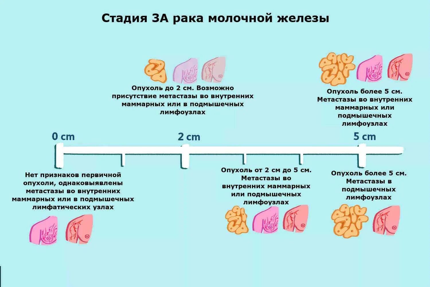 Последние стадии рака фото Стадии рака груди у женщин