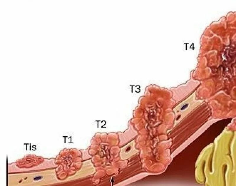 Последние стадии рака фото Рак предстательной железы: коротко о важном Prostate Center Europe