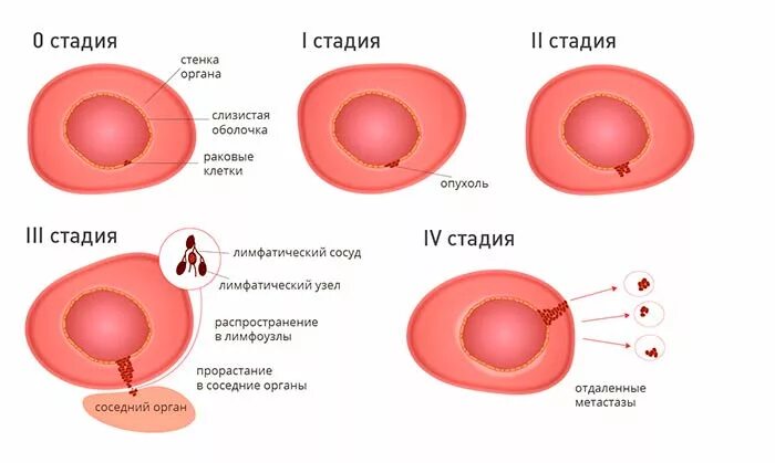 Последние стадии рака фото Стадии рака: какие бывают и как определяются, как быстро развивается рак, класси