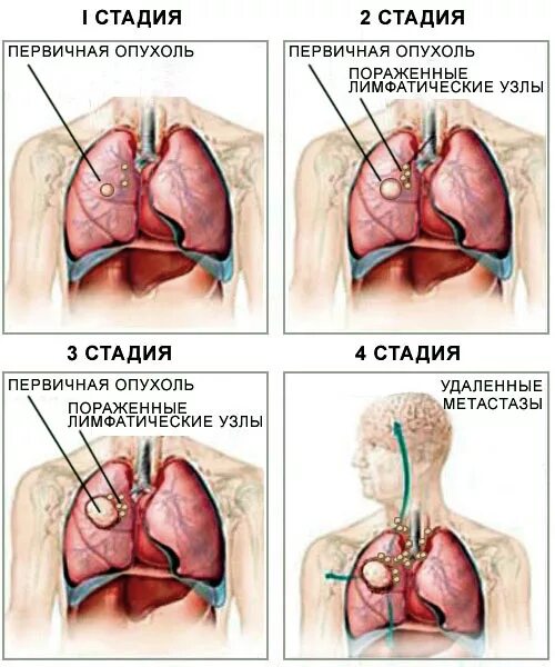 Последние стадии рака фото Симптомы рака: как распознать онкологию на ранних стадиях