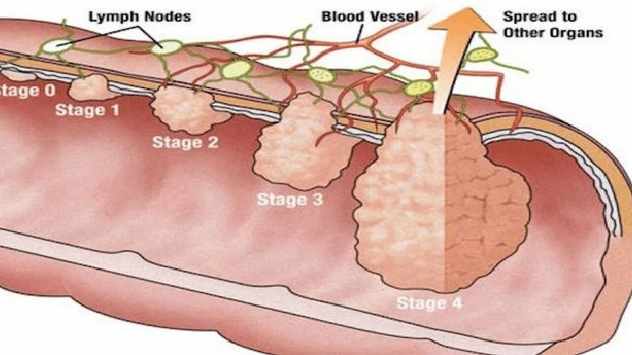 Последние стадии рака фото 7 Early Warning Signs of Rectal Cancer Everyone is Too Embarrassed To Talk About