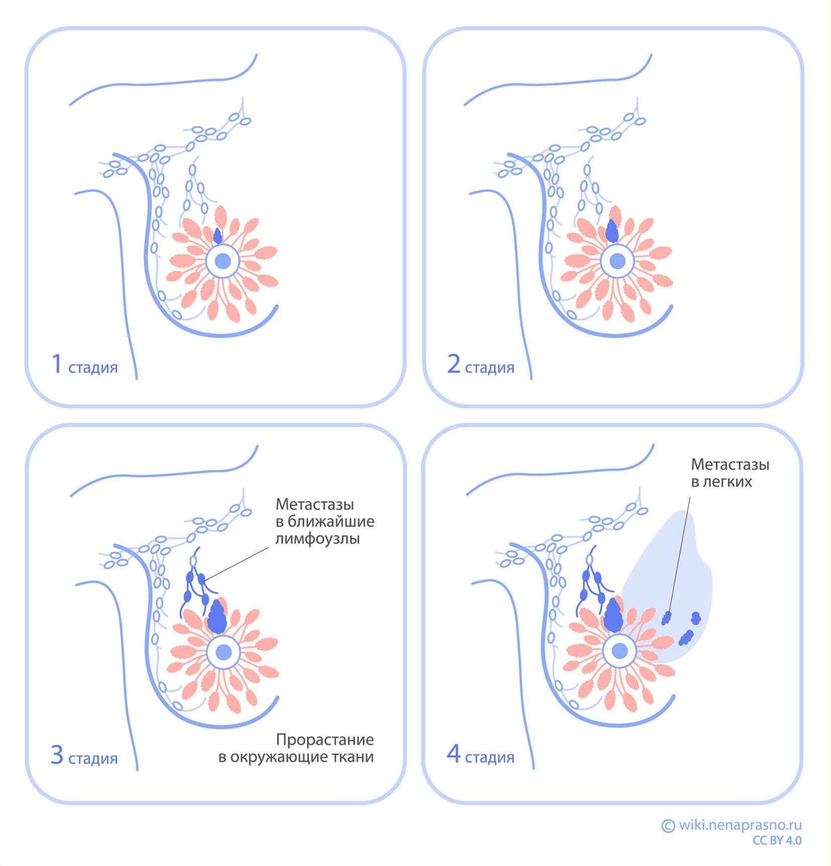 Последние стадии рака фото Онко Вики - Стадии рака молочной железы