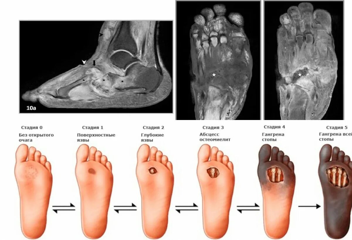 Последняя стадия гангрены ноги фото Синдром диабетической стопы: симптомы, профилактика и лечение