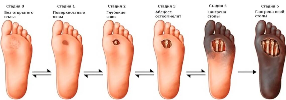 Последняя стадия гангрены ноги фото Диабетическая стопа: причины, симптомы, виды, лечение, когда нужна ампутация, ка