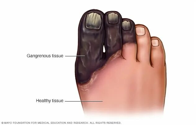 Последняя стадия гангрены ноги фото Gangrene of the foot - Mayo Clinic