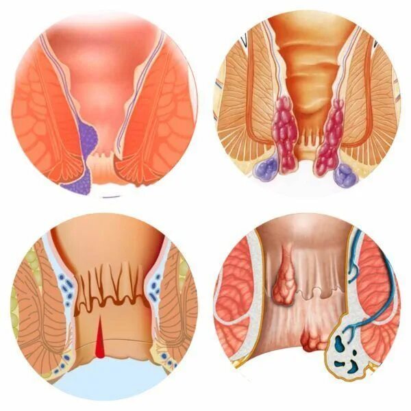 Последняя стадия геморроя фото Pin on Health