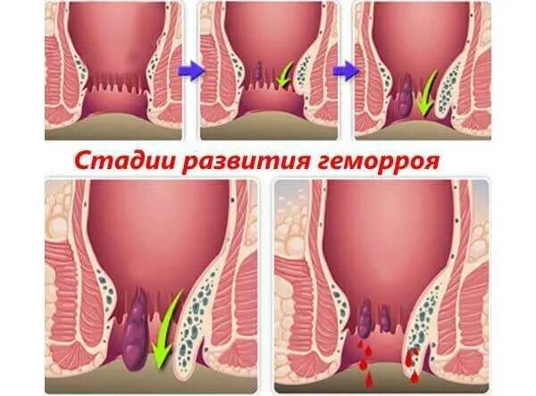 Последняя стадия геморроя фото Стадии геморроя схема