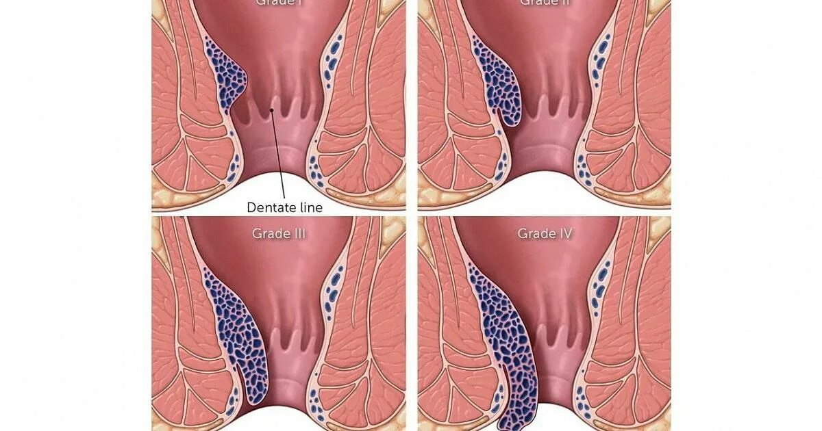 Последняя стадия геморроя фото Выпадение геморроидальных узлов фото Happy-laser.ru
