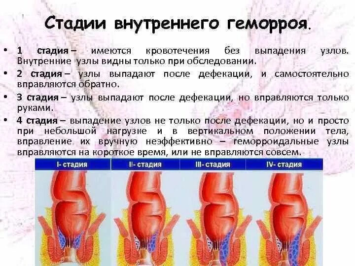 Последняя стадия геморроя фото Геморрой кровотечение карта вызова