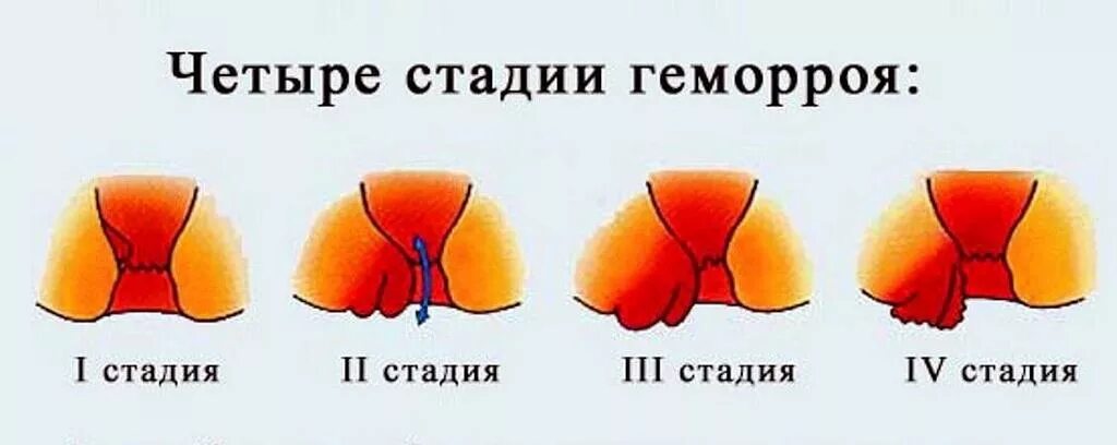 Последняя стадия геморроя фото Чем лечить геморрой при беременности: консервативная терапия, медикаментозное ле