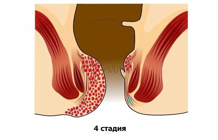 Последняя стадия геморроя фото Геморрой 4 стадии (последней) - лечение геморроя четвертой стадии