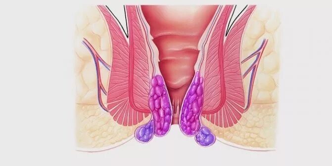 Последняя стадия геморроя фото ⛑ Геморрой 2 степени: стадии лечения и профилактика