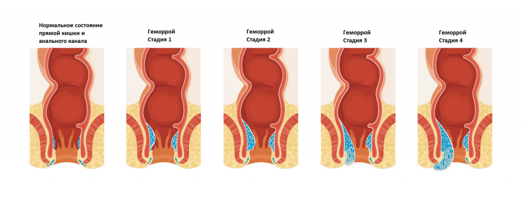 Последняя стадия геморроя фото Геморрой