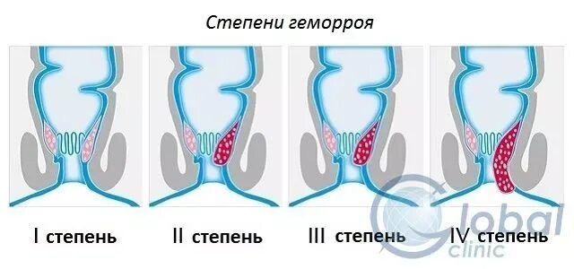 Последняя стадия геморроя фото Степени геморроя ЦМ "Глобал клиник" - услуги в области проктологии, урологии, ги