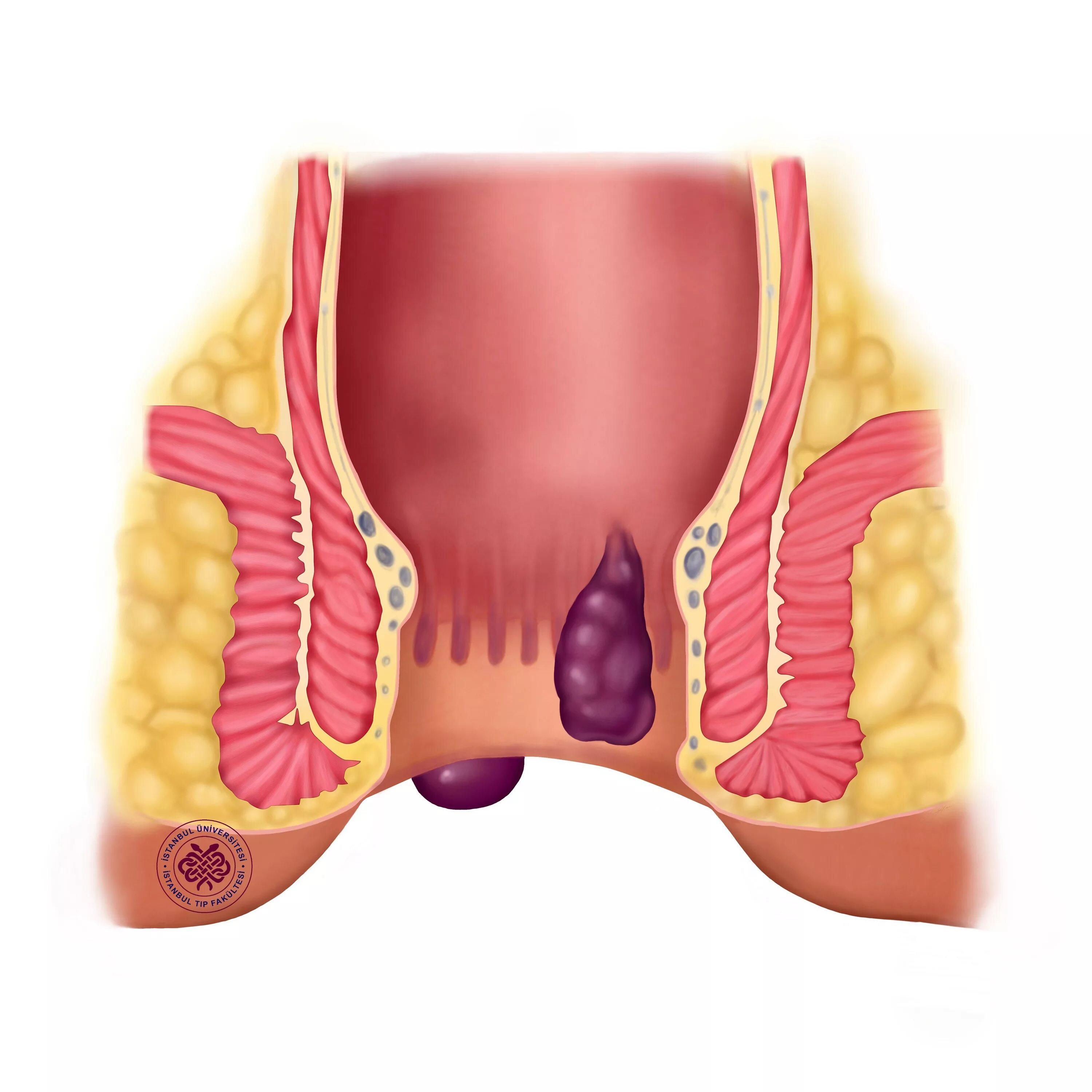 Последняя стадия геморроя фото Hemoroid Türk Cerrahi Derneği